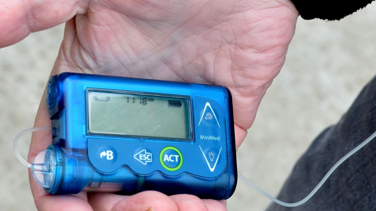Medtronic urgently recalls insulin pump controllers over hacking concerns